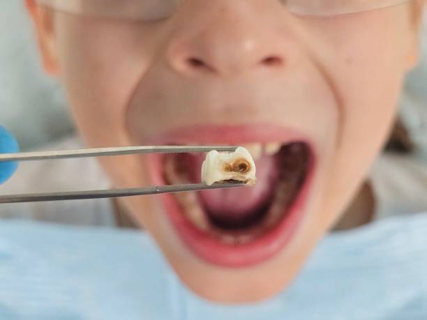 Best Same-Day Emergency Dental Services in Fobes Hill, WA